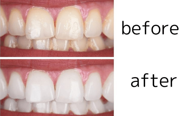セルフホワイトニング Before After